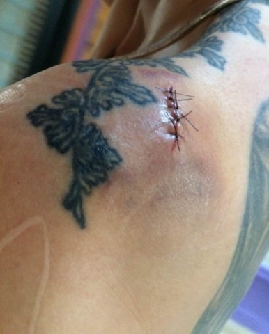 Day 2 with stitches in place and substantial bruising Thumbnail