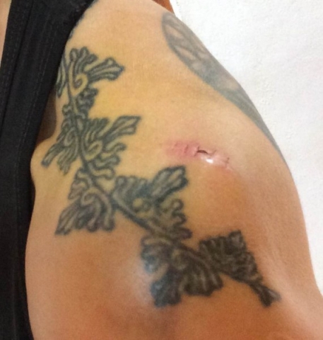 Stitches have been removed and only a tiny scab remains Thumbnail
