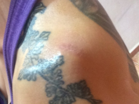 Day 12 fully healed Thumbnail