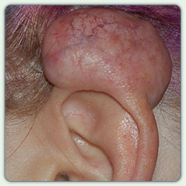 Enormous keloid on ear cartilage from a piercing Thumbnail