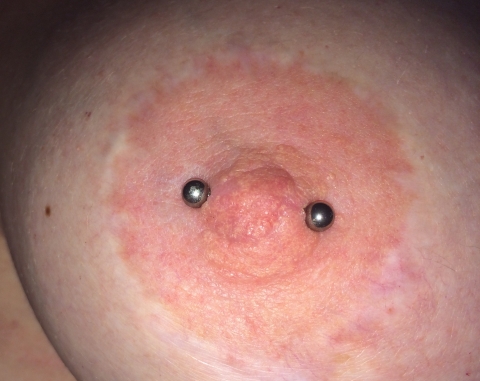 Nipple piercing with barbell on post-surgical anatomy Thumbnail