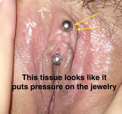 Accidental Clitoris Piercing causing pressure Thumbnail