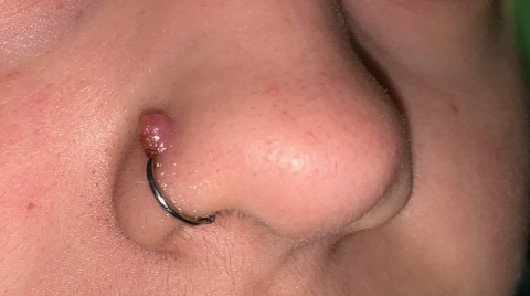 how to get rid of bubble around nose piercing