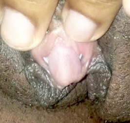 An accidental puncture of the clitoral glans from attempted triangle piercing