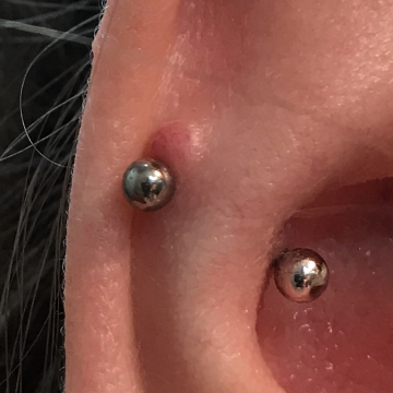 False Snug Piercing with Possible Keloid Thumbnail