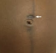 Atrophic Scar Thumbnail