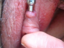 Excess scar tissue Thumbnail