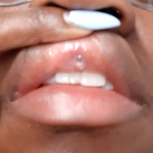 Lip bump philtrum Thumbnail